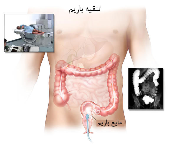 آزمایش تنقیه باریم