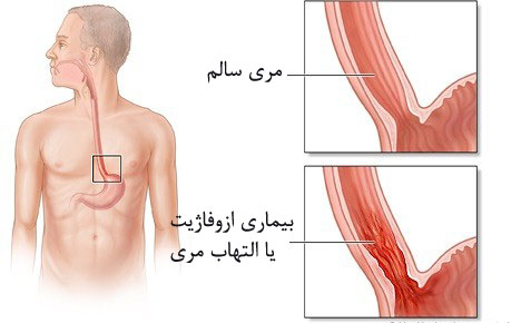 ورم، التهاب و سوزش مری