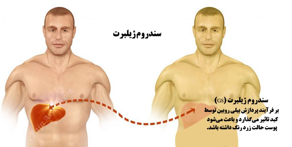 سندرم ژیلبرت