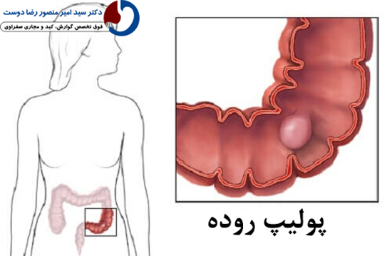 پولیپ روده بزرگ